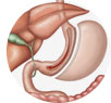 Gastric Sleeve / Sleeve Gastrectomy